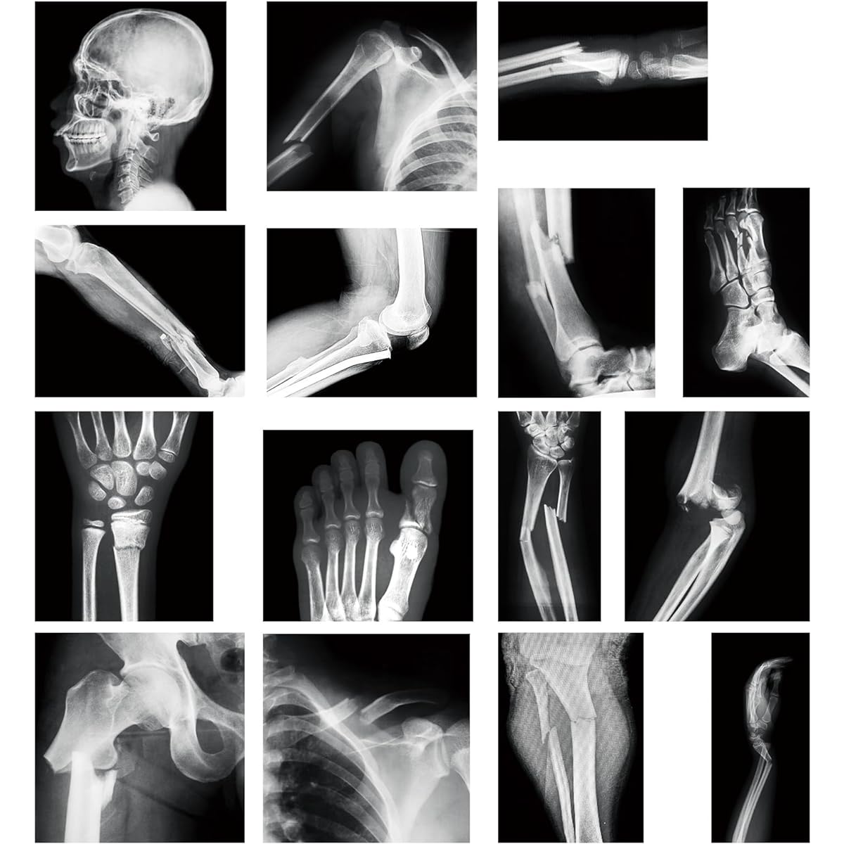 Sayglossy 15pcs Broken Bones X-Ray Set, Human X-Ray Black and White Skeleton Pretend X-Ray for Kids