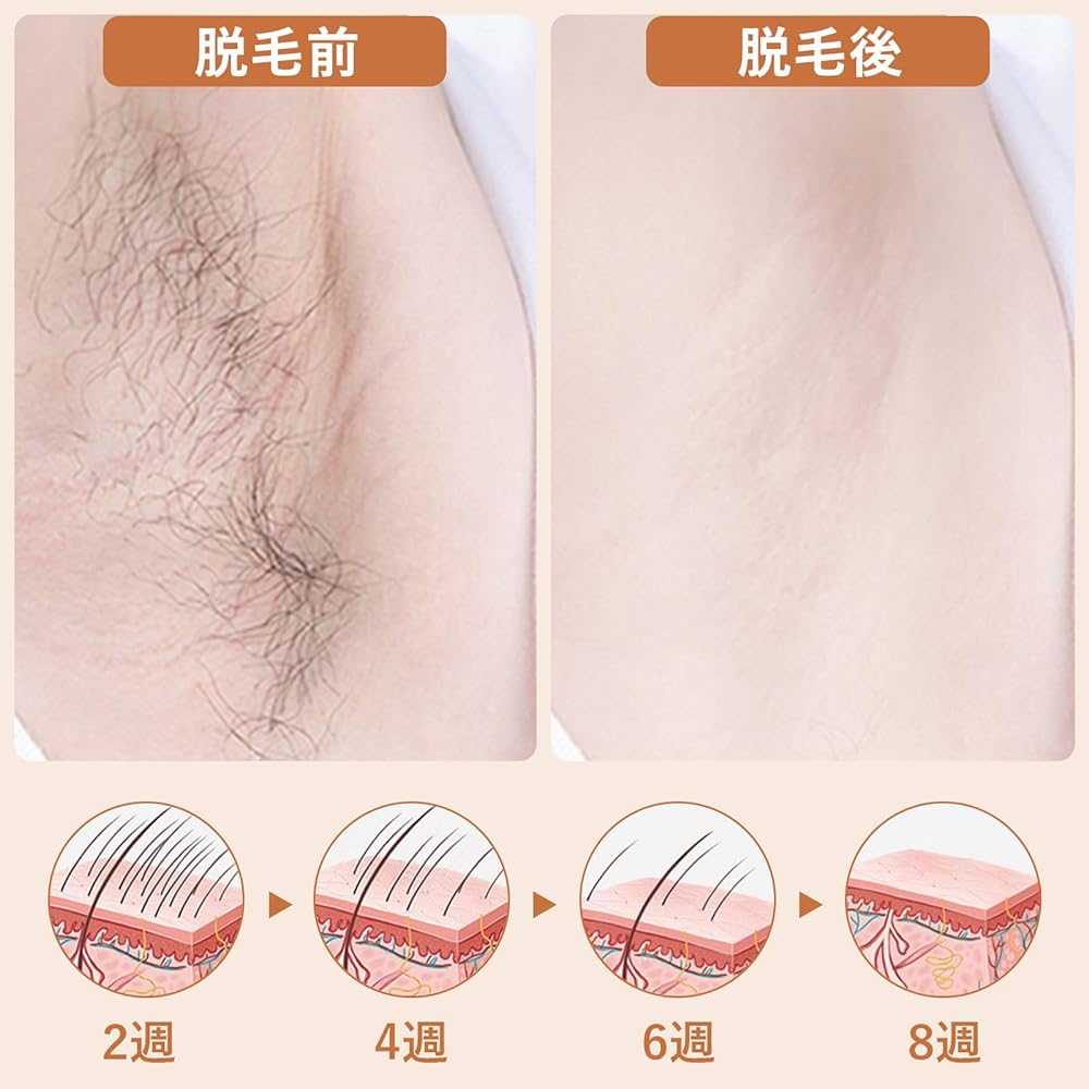 Hair removal device, 990,000 times irradiation, permanent hair removal, IPL light hair removal device, light beauty device, 5 steps, home use hair removal device, unwanted hair care, unisex, full body hair removal possible, Japanese instructions included