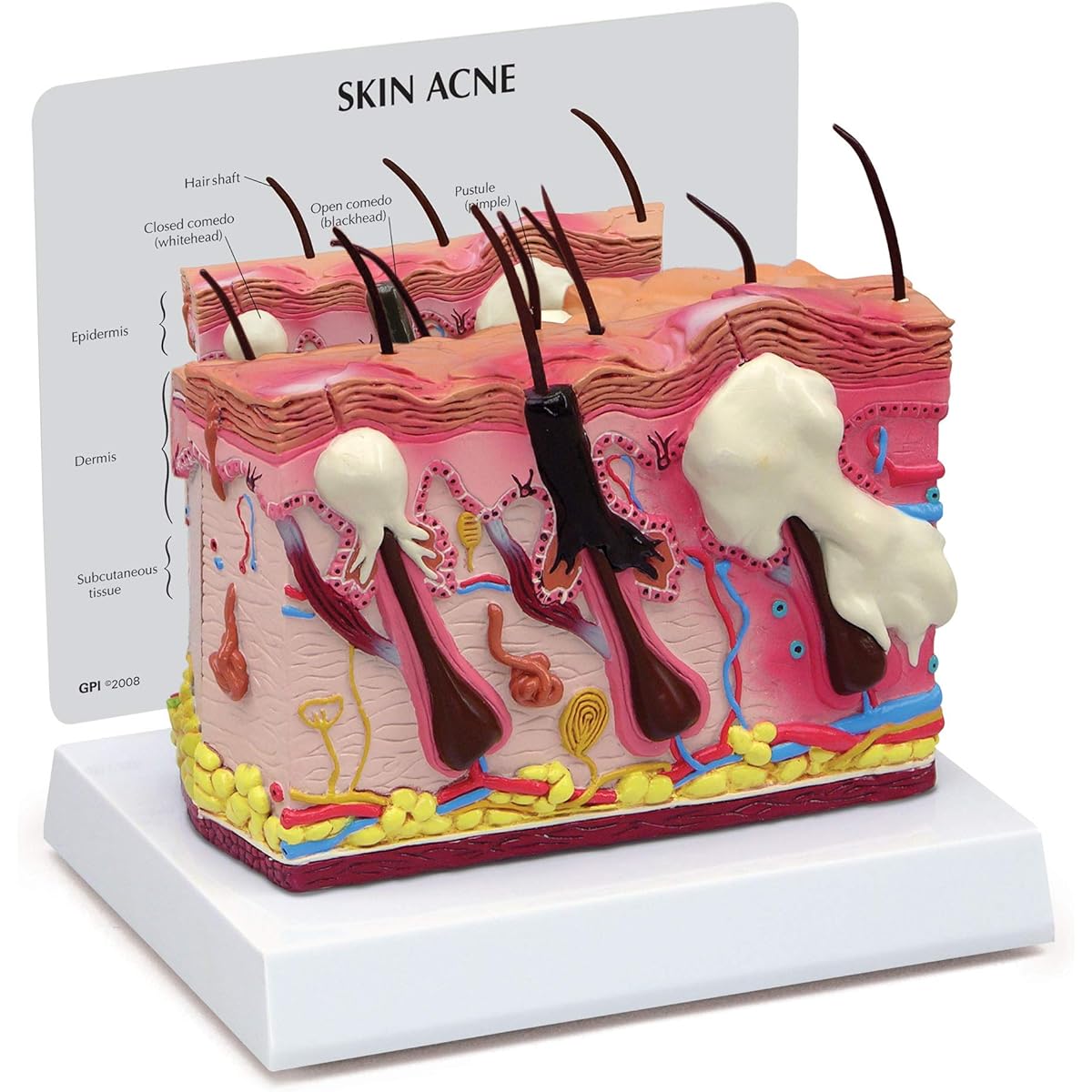 GPI Anatomicals - Skin Acne Model Cross Section View Skin Covering Normal and Common Acne Human Anatomy Physiology Education Anatomical Model Medical Learning Resources